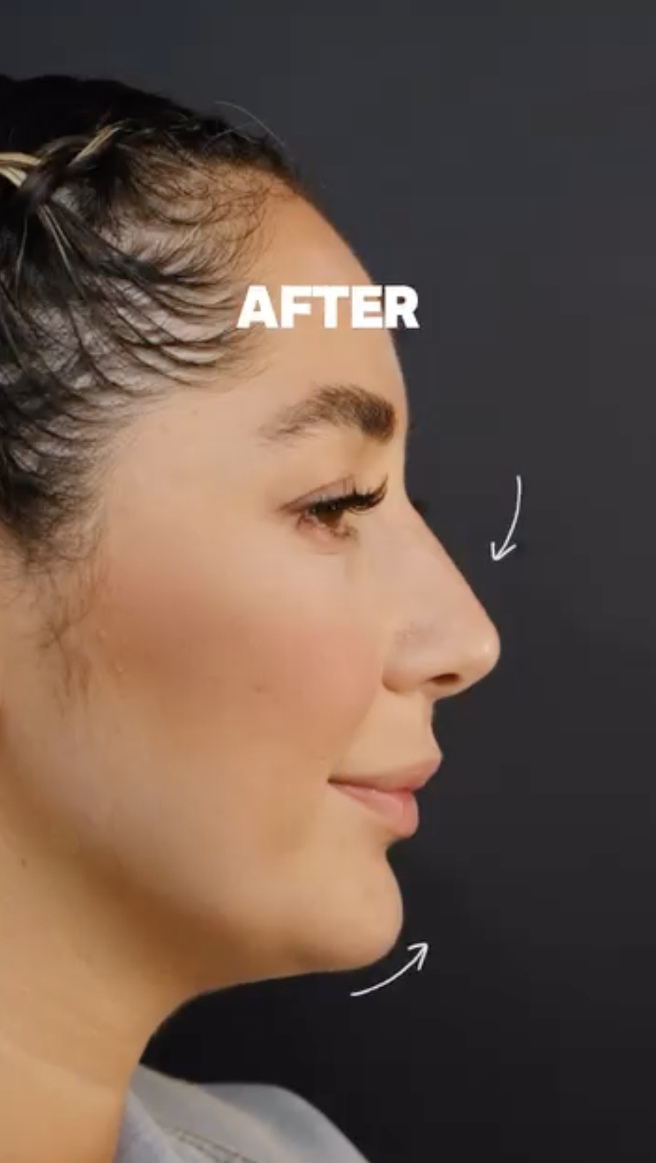 Non-Surgical Nose Job, after
