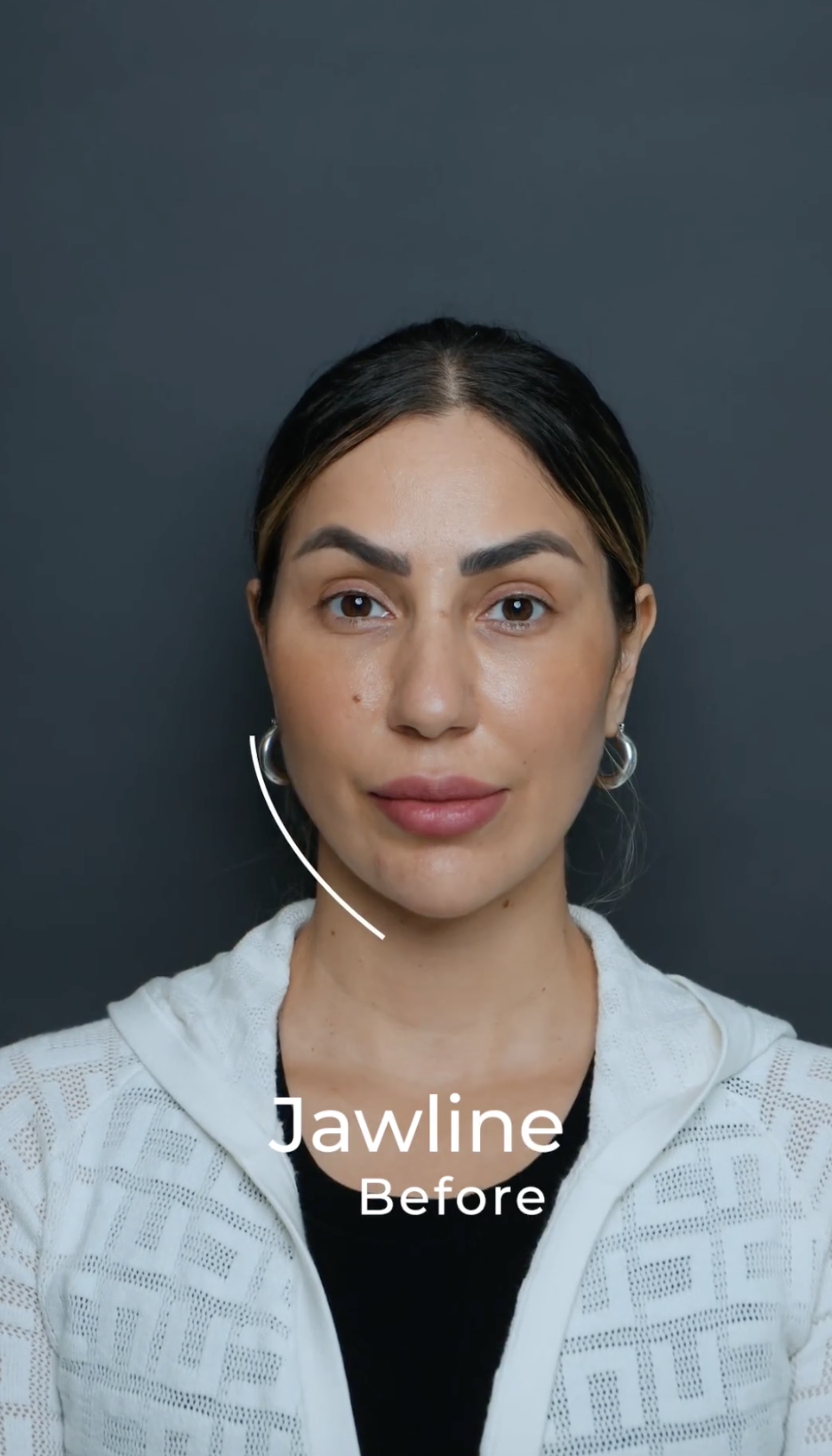 Face Remodeling · Jawline Sculpt, before