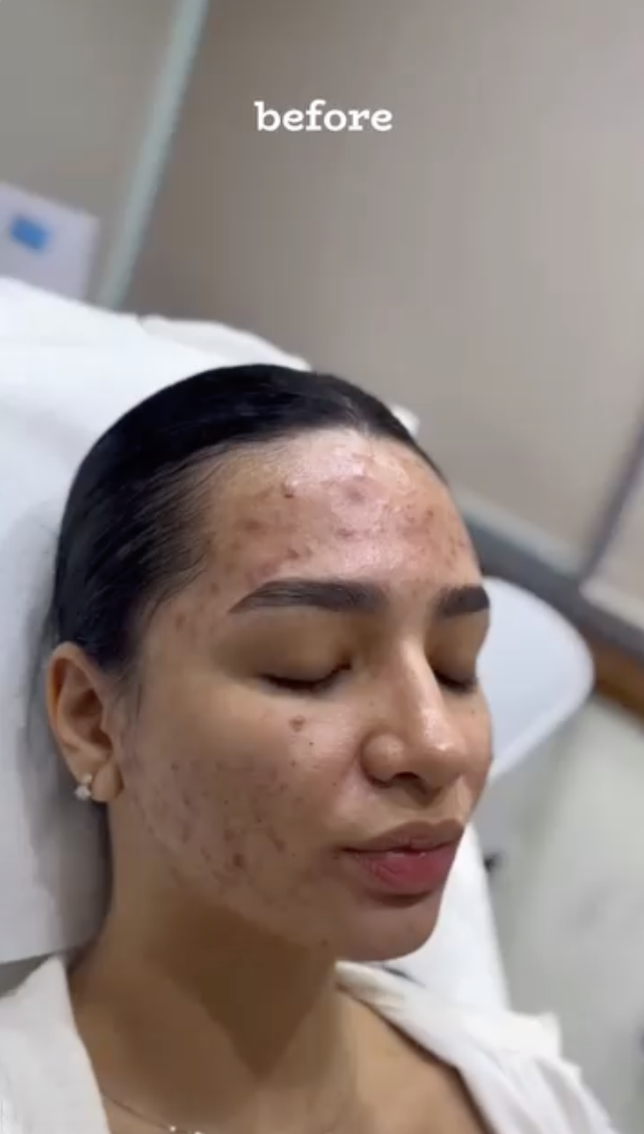 Acne Treatment, before