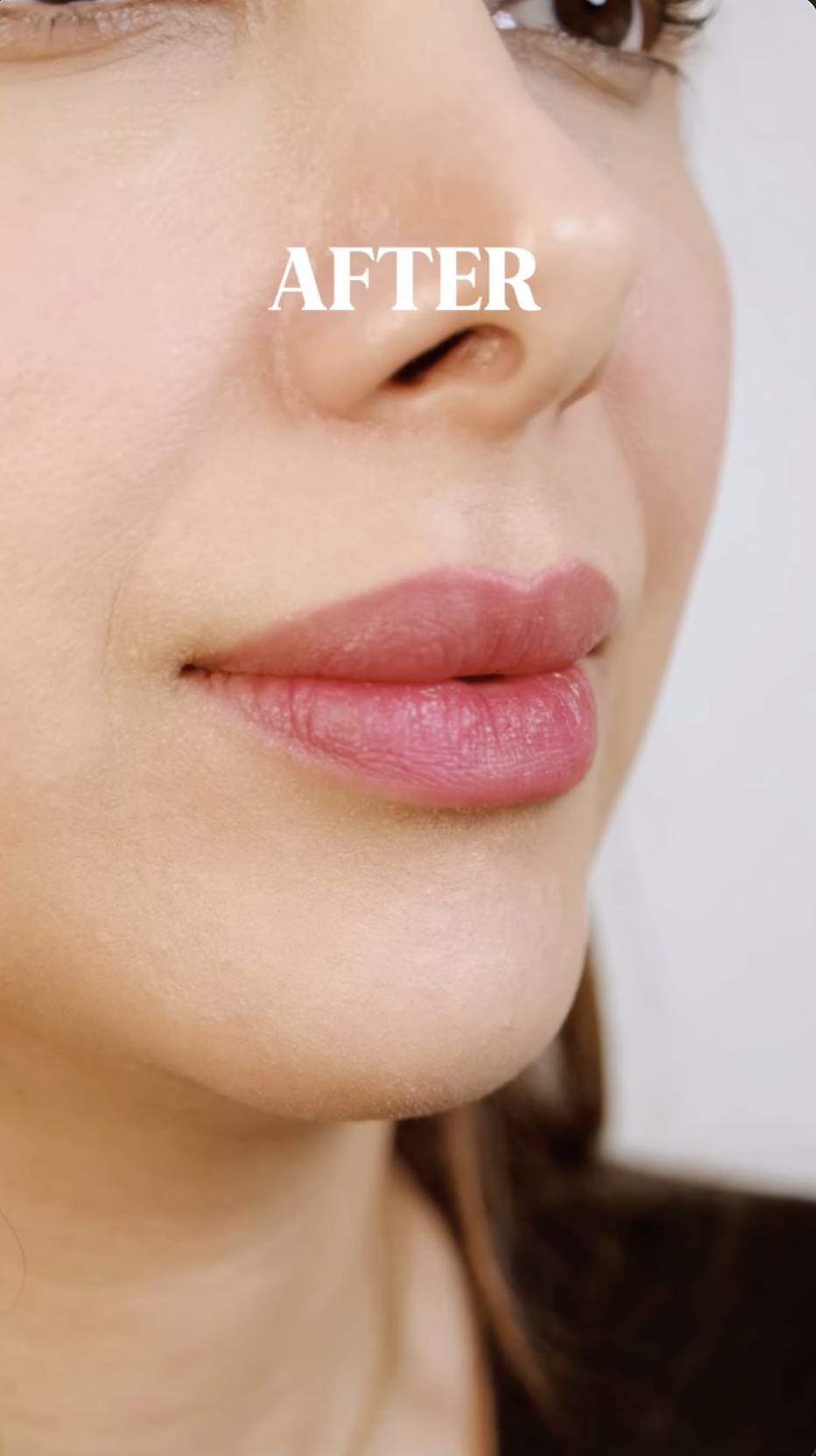 Lip Filler · Dr. Giti Signature, after