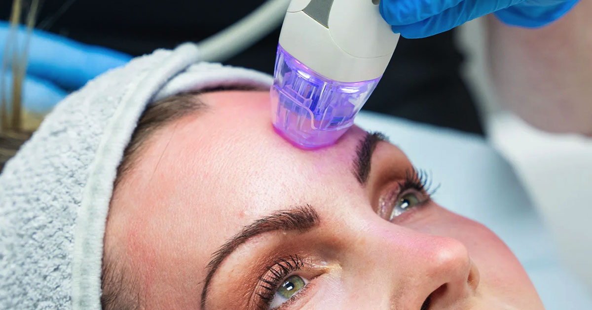 RF Microneedling treatment with Dr. Giti