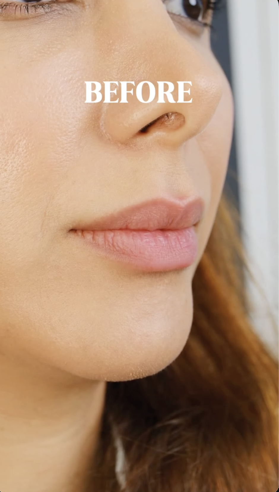 Lip Filler · Dr. Giti Signature, before